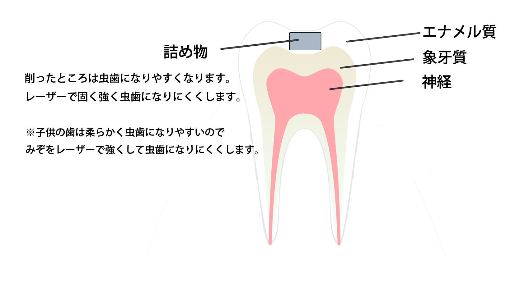 歯も生きています。 神経を取ってしまうと死んでしまい弱くなってしまいます。 神経に近いところをレーザーで強くし、神経を保護し、歯を長持ちさせます
